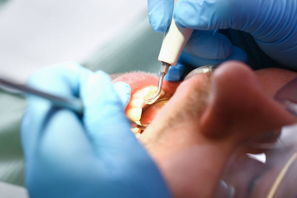 Best Emergency Tooth Extraction in Kearns, UT