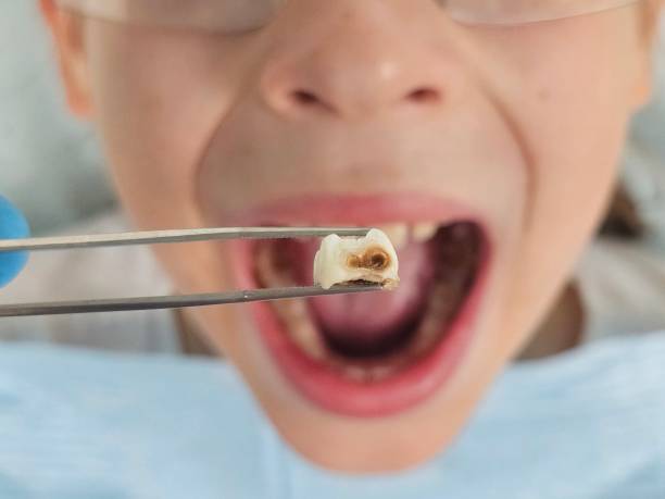 Best Emergency Treatment for Toothache in Kearns, UT